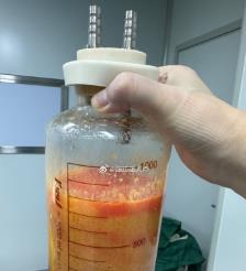 烟台水动力吸脂手术要做多久？